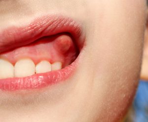 عفونت دندان و آبسه دندان کودک